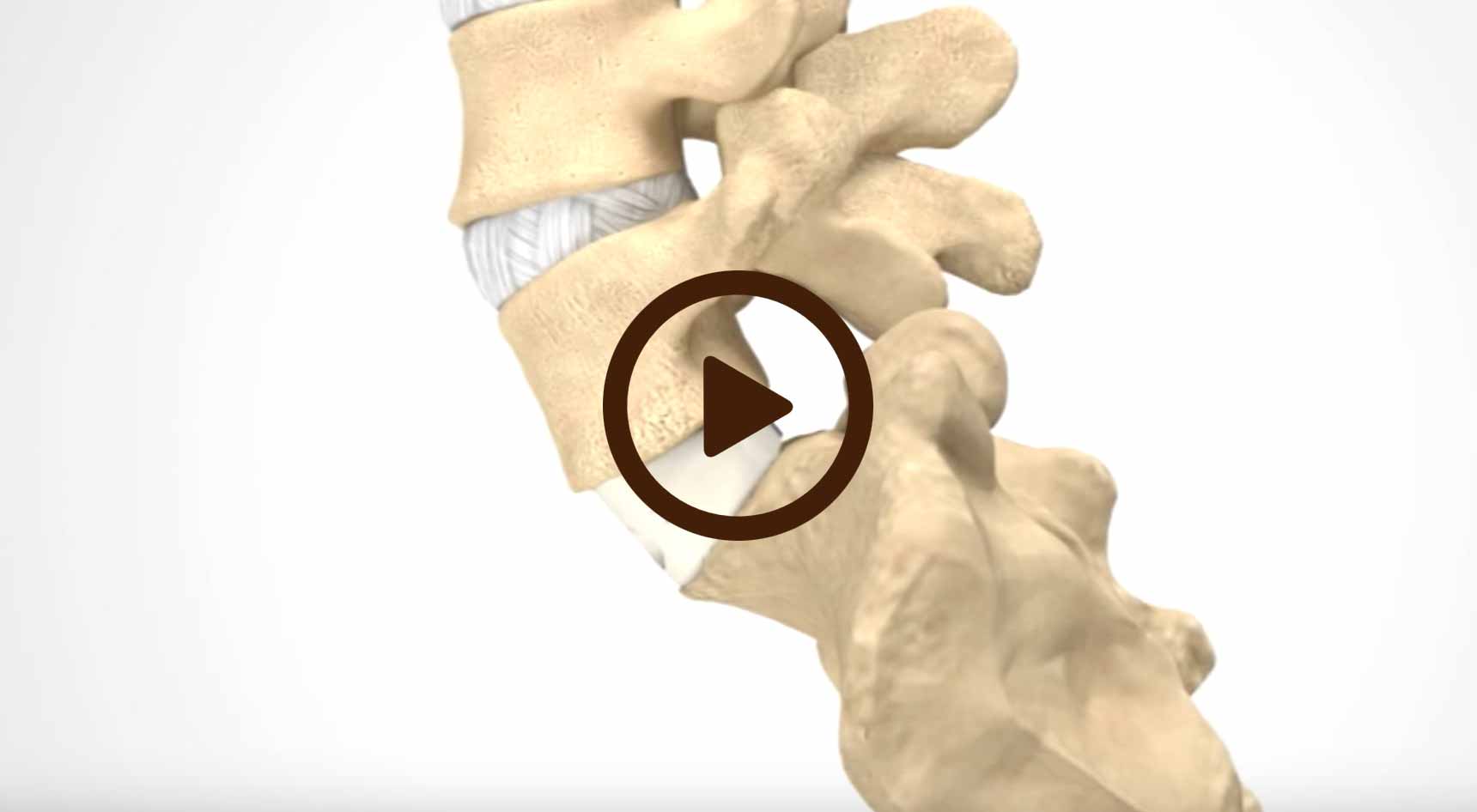 Anterior Lumbar Interbody Fusion - ALIF - Beach Orthopedic Specialty ...