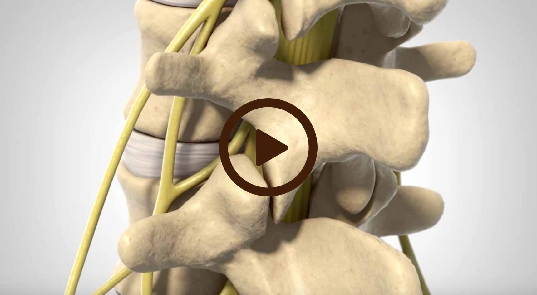 Lumbar Spinal Stenosis Video