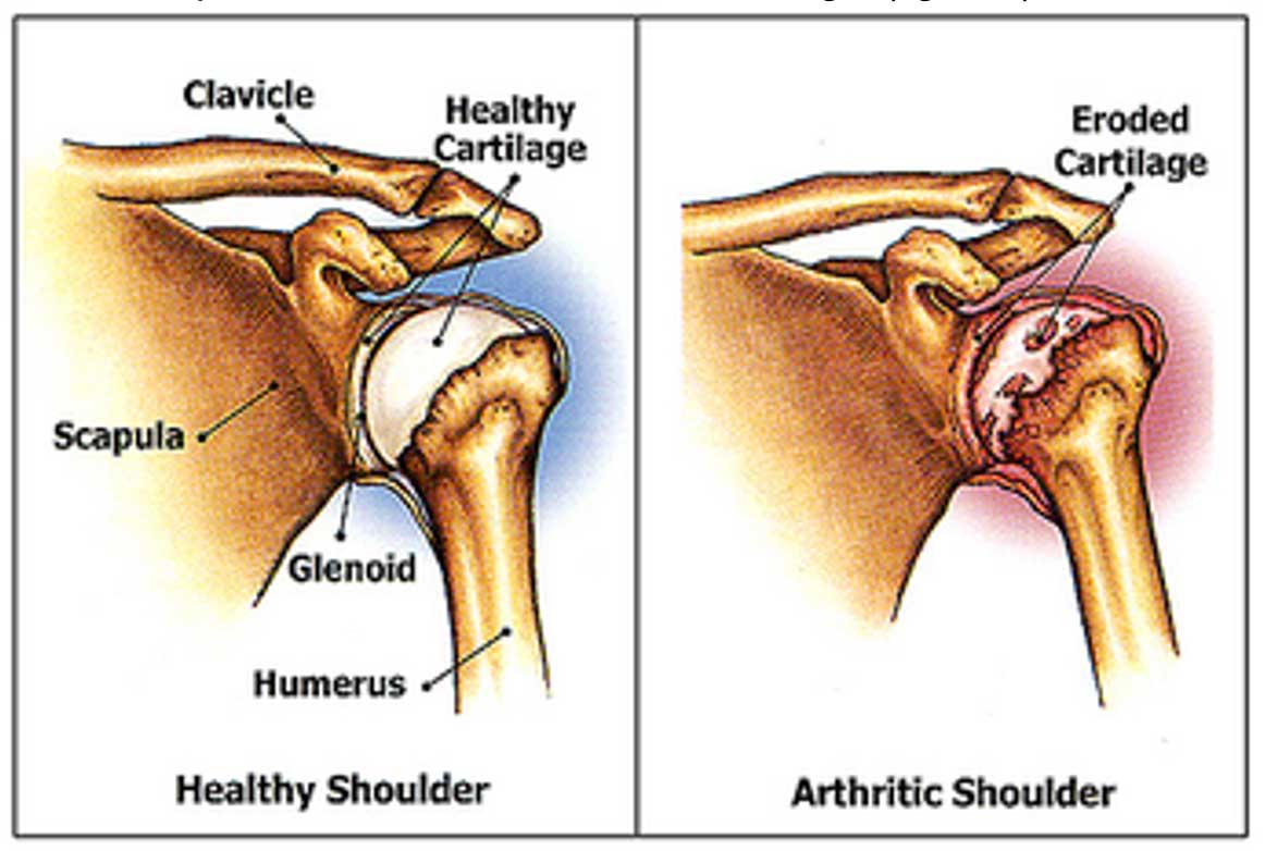 shoulder cartilage