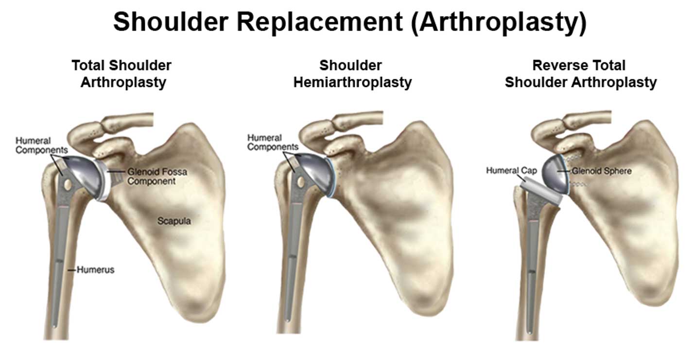 Shoulder Replacement Arthroplasty